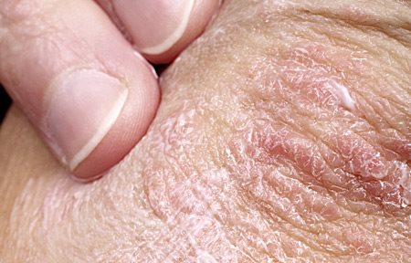 Las separaciones a la psoriasis