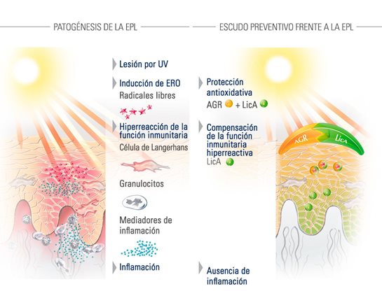 El acné en forma de los puntos negros