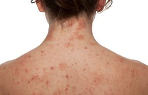 Espalda de una mujer con la piel infectada.