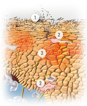 Ilustración de la piel con síntomas de la dermatitis atópica.
